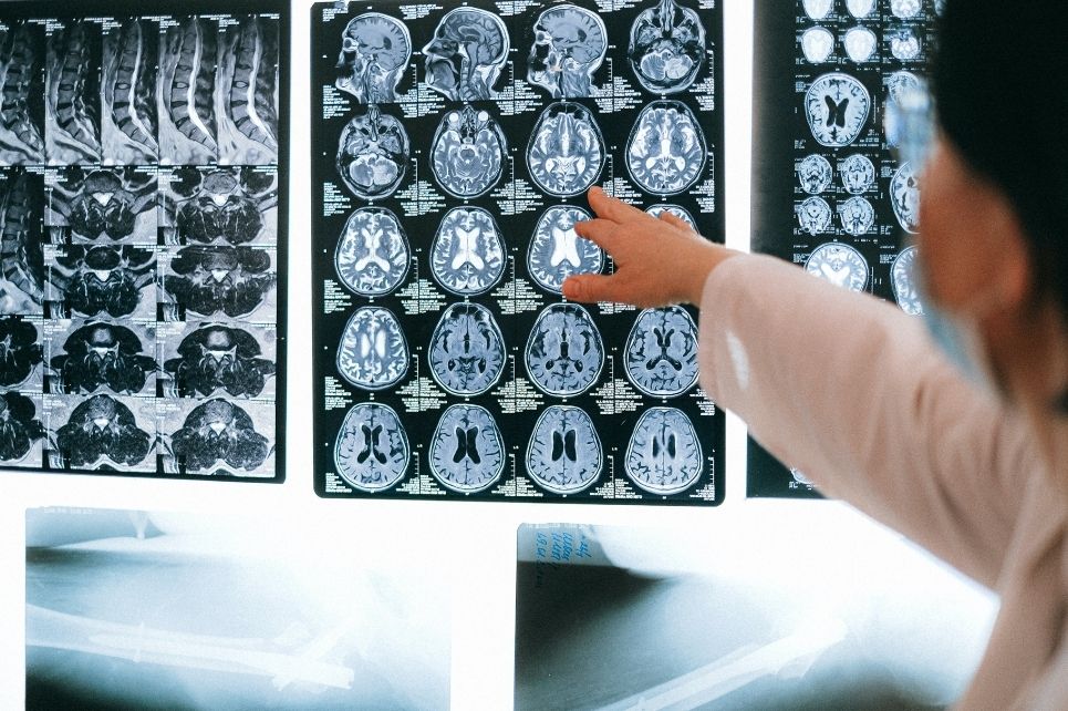 Hlavní obrázek - Syndrom arteria mesenterica superior v souvislosti s Crohnovou chorobou – kazuistika